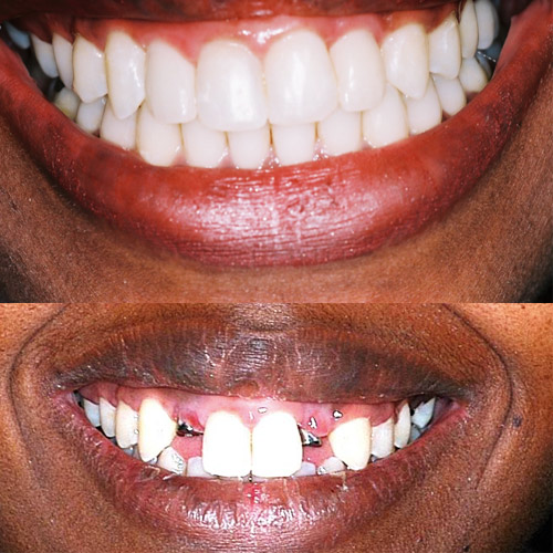 Dental Implants: Before and After