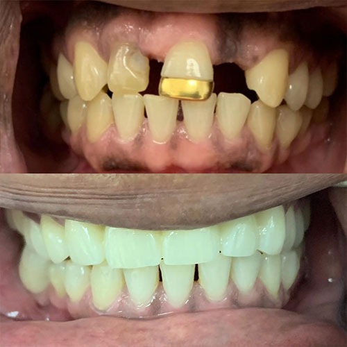 Dental Implants: Before and After