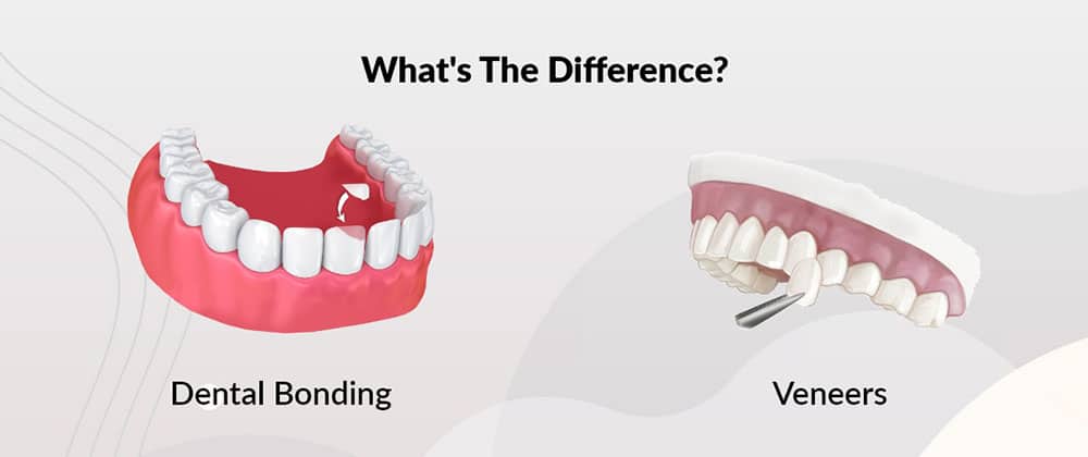 Veneers vs. Bonding