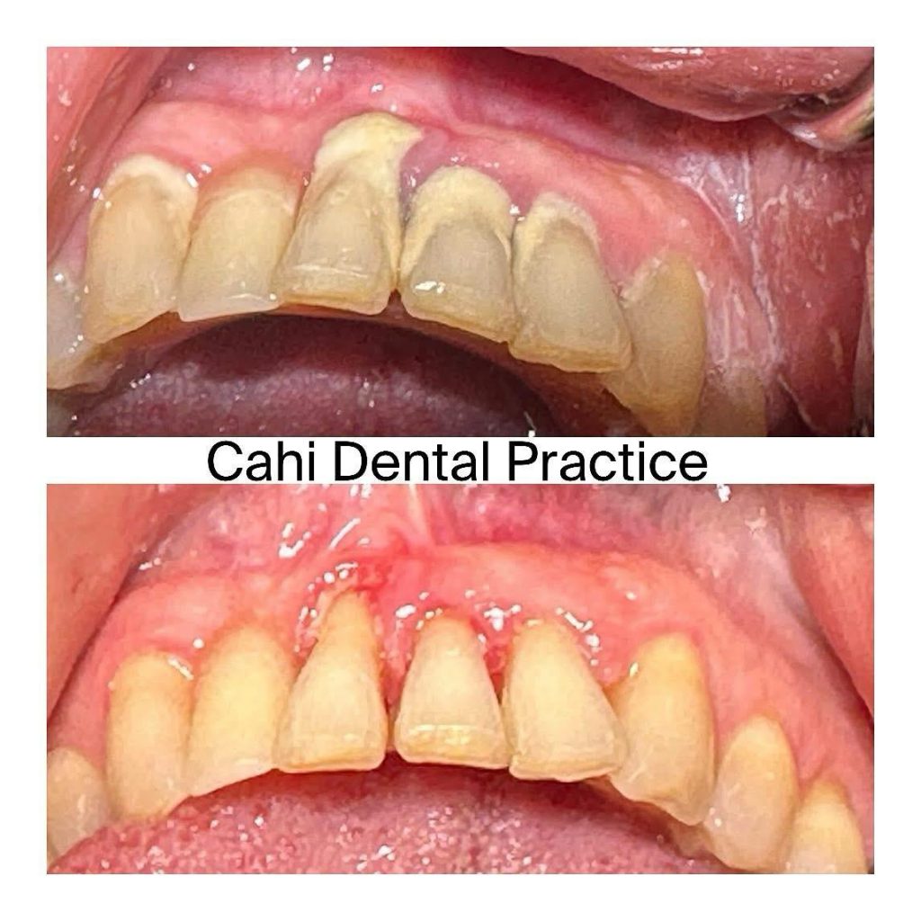 gum disease,Prevent Gum Disease